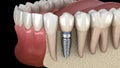 Premolar tooth recovery with implant