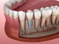 Premolar tooth recovery with implant. Medically accurate 3D illustration of human teeth and dentures