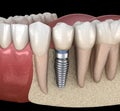 Premolar tooth recovery with implant. Medically accurate 3D illustration of human teeth and dentures