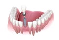 Premolar tooth recovery with implant. Medically accurate 3D illustration of human teeth and dentures concept