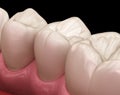 Premolar tooth restoration with filling. Medically accurate tooth illustration