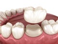 Preparated molar tooth for dental crown placement. Medically accurate illustration