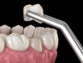 Preparated premolar tooth and ceramic crown placement. Medically accurate 3D illustration