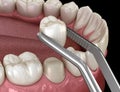 Preparated premolar tooth and ceramic crown placement. Medically accurate 3D illustration