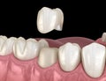 Preparated premolar tooth for dental crown placement. Medically accurate illustration