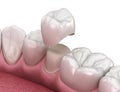 Preparated premolar tooth and dental crown placement. Medically accurate 3D illustration Royalty Free Stock Photo
