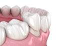 Preparated premolar tooth and dental crown placement. Medically accurate 3D illustration Royalty Free Stock Photo