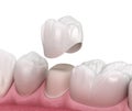 Preparated premolar tooth and dental crown placement. Medically accurate 3D illustration Royalty Free Stock Photo