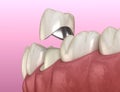 Preparated premolar tooth and dental metal-ceramic crown. Medically accurate 3D illustration