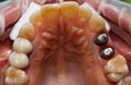 Preparation for prosthetic teeth. Teeth restored with the help of metal pins and processed for prosthetics with crowns.