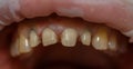 Preparation for prosthetic teeth. Teeth treated for prosthetics with crowns. Retraction of the gums.