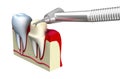 Preparation of the tooth crown for prosthetics