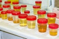Preparation of urine samples in the laboratory in the hospital for the study. Special test strips for urine examination