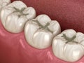 Prepareted Molar Fissure for fillings placement, Medically accurate 3D illustration of dental concept