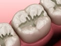 Prepareted Molar Fissure for fillings placement, Medically accurate 3D illustration of dental concept