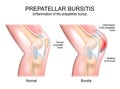 Prepatellar bursitis. inflammation of the prepatellar bursa