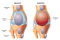 Prepatellar bursitis 