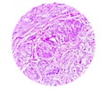 Prepatellar region histology showing Bursitis, acute or chronic Bursitis.