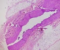 Prepatellar region histology showing Bursitis, acute or chronic Bursitis.