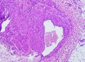 Prepatellar region histology showing Bursitis, acute or chronic Bursitis.