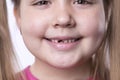 A preschool girl with her first adult incisors. The milk tooth has fallen out, and a permanent tooth grows in the open Royalty Free Stock Photo