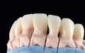 Natural look press ceramic veneers and crowns on dental plaster model. Close-up ceramic tooth crown. Dental prosthesis Royalty Free Stock Photo