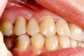 Pressed ceramic teeth in oral cavity