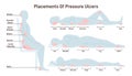 Pressure ulcers placements. Pressure sores areas on human body part