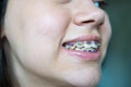 Pretty teenage girl wearing braces smiling cheerfully Royalty Free Stock Photo