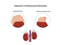 Primary aldosteronism causes: adrenal tumor and hyperplasia