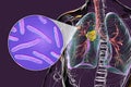 Primary lung tuberculosis, 3D illustration