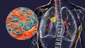 Primary lung tuberculosis, 3D illustration