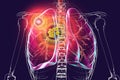 Primary lung tuberculosis, 3D illustration