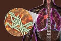 Primary lung tuberculosis, 3D illustration