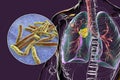 Primary lung tuberculosis, 3D illustration