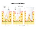 Primary tooth and permanent tooth. Process is root resorption.