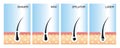 Diagram of laser hair removal.laser hair removal vector.