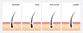 Diagram of laser hair removal.laser hair removal vector.