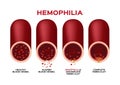 Hemophilia or haemophilia and blood vessel vector / bleeding / wound Royalty Free Stock Photo