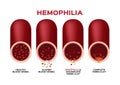 Hemophilia or haemophilia and blood vessel vector / bleeding / wound