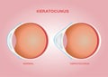 Eye cornea and keratoconus vector / anatomy