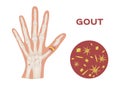 Gout in human hand vector / human, anatomy