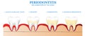 Educational poster about dental and gum health Teeth cleaning, maintain healthy, prevent tooth decay Concepts of oral education an Royalty Free Stock Photo