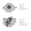 Vector illustration of malignant and benign tumor