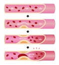 Progression of arteriosclerosis illustration