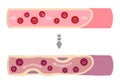 Illustration of healthy blood becomimg muddy blood