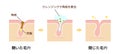 Structure illustration of pores cleansing / Japanese