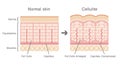 Comparative illustration of normal skin and cellulite`s skin