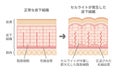 Comparative illustration of normal skin and cellulite`s skin