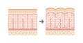 Comparative illustration of normal skin and cellulite`s skin